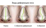 burun-eğriliği