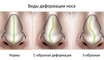 burun-eğriliği