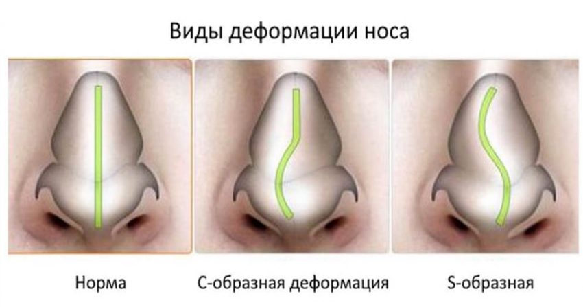 Nefes almakta güçlük çekiyorsanız sorun bu olabilir