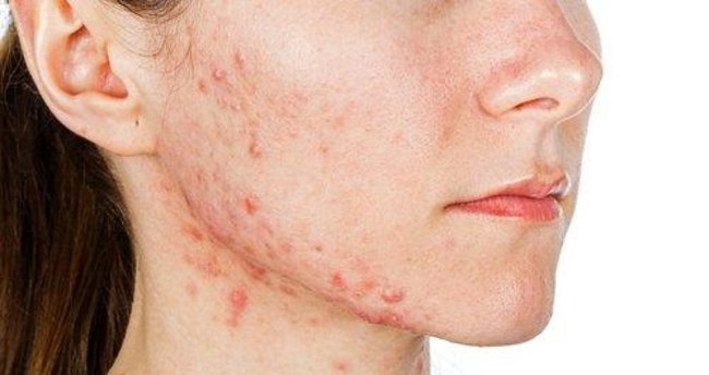 Akne sivilcesi neden olur, yediklerimizle ilgisi var mı, akne nasıl geçer?