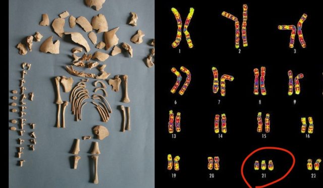 down sendromu tarih öncesi