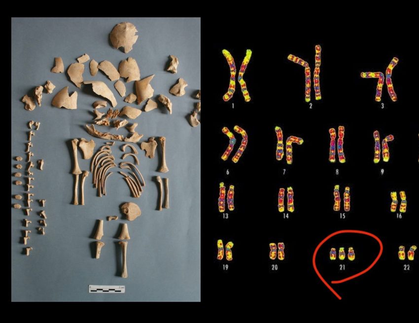 Dünyanın en eski Down Sendromlu bireylerinin iskeletleri bulundu